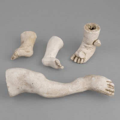 Orthopedic Plaster Casts of Children between 1900 and 1930